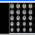 基于VTK的三维医学图像可视化处理系统