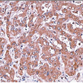肝细胞肝癌患者中血清乙酰肝素酶与微血管侵袭的关系