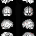 缺血性中风患者外关穴巨刺fMRI脑功能成像的研究