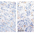Twist 1,MMP-2及MMP-9在肝细胞肝癌血管生成中的表达及意义