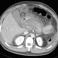 急性胰腺炎累及胃裸区的MSCT表现及其与Balthazar CT分级的相关性研究 	 