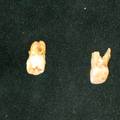  Si0x/PMMA牙体修复纳米复合材料的研究及应用