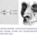 定向曲面牵引成骨技术及其在颅眶部的应用