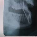 下颌第三磨牙高位阻生非拔除治疗36例临床观察